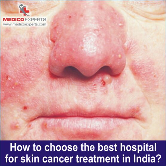best hospital for skin cancer treatment in india, best skin cancer hospital in india