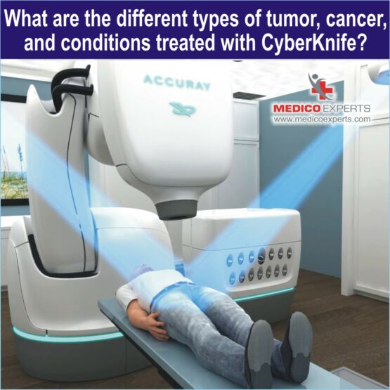 Cyberknife Treatment