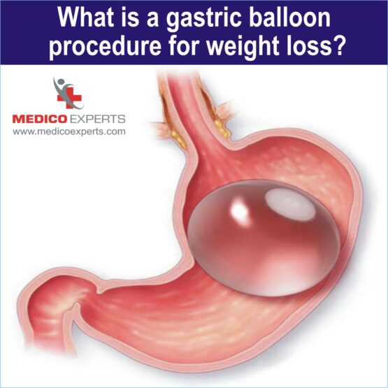 what is gastric balloon surgery