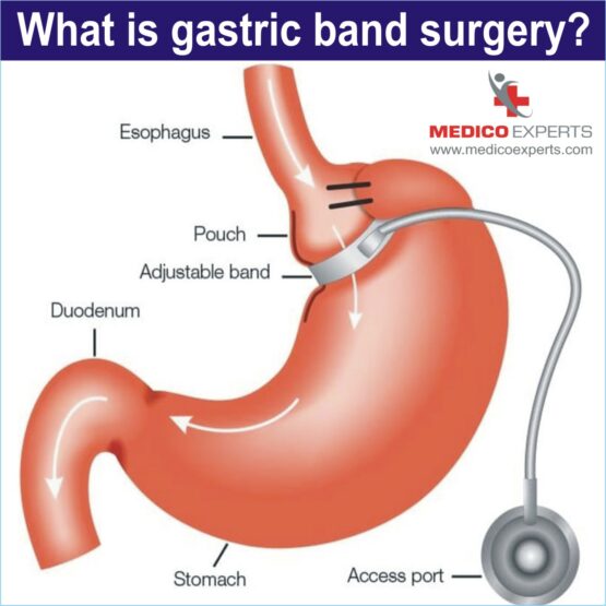 what is gastric banding surgery, gastric band surgery in india