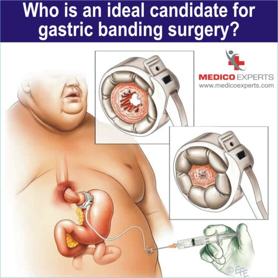 ideal candidate for gastric banding surgery