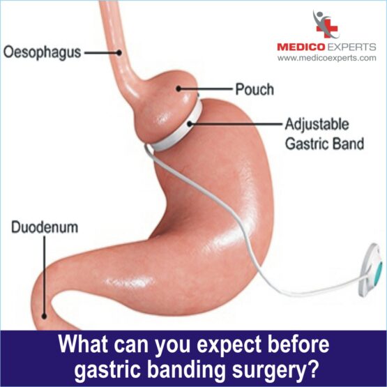 gastric banding surgery gastric banding surgery, gastric band side effects, gastric band before and after