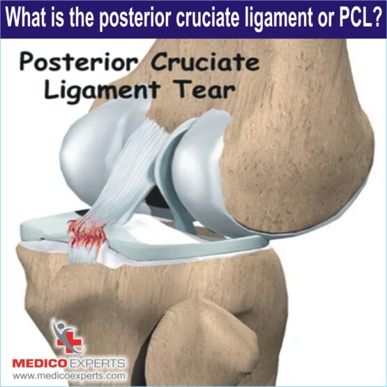 what is pcl ? pcl ligament surgery, arthroscopic pcl reconstruction, pcl tear treatment