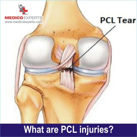 what is pcl injury, pcl reconstruction surgery, pcl tear treatment