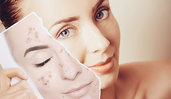 Silk-Cotton-face-pack-for-pimples-2 Silk Cotton face pack for pimples