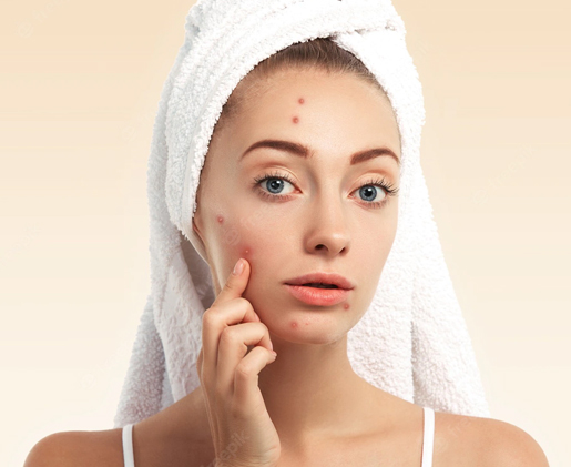 face-pack-for-pimples face-pack-for-pimples