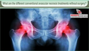 avascular necrosis treatment without surgery