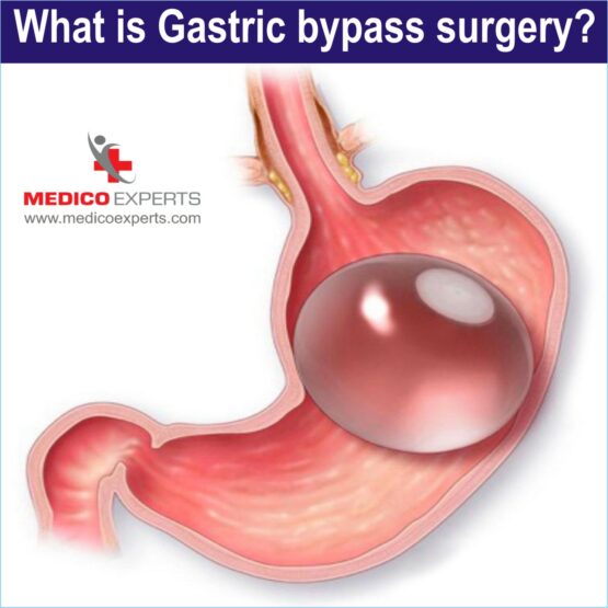 what is gastric bypass surgery in indiagastric bypass surgery