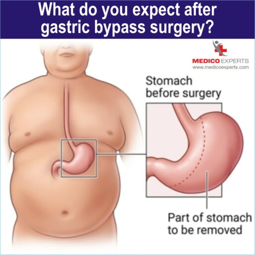 gastric bypass, gastric bypass surgery in india