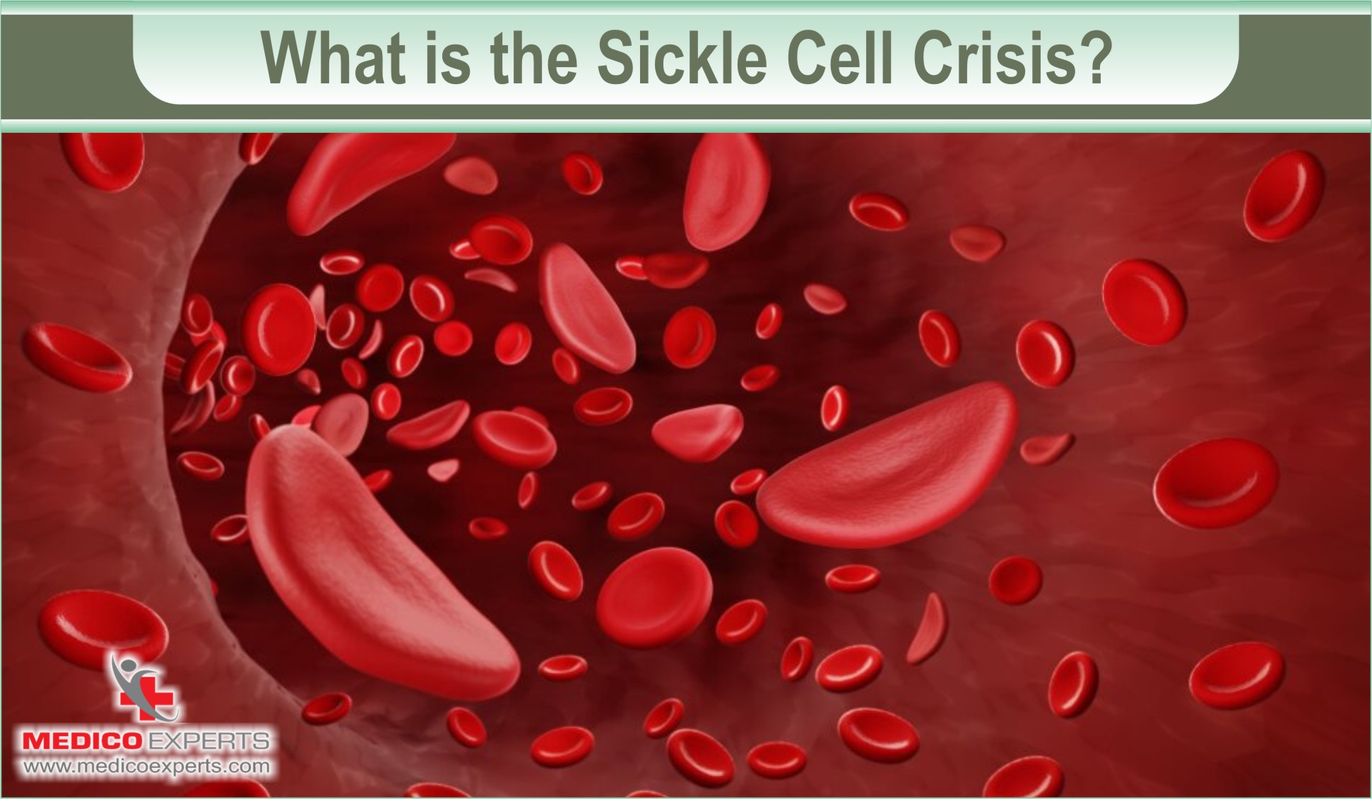 Avoid sickle cell crisis with bone marrow transplant