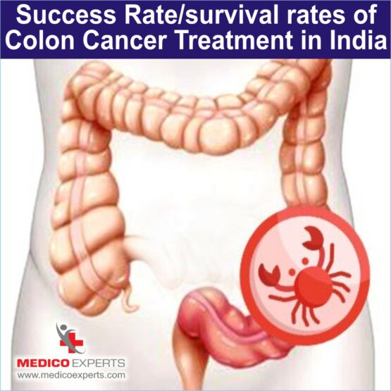 Success Rate survival rates of Colon Cancer Treatment in India