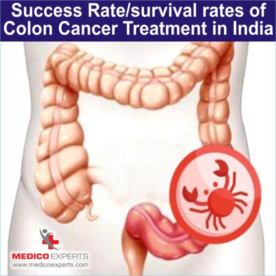 Success Rate survival rates of Colon Cancer Treatment in India Success Rate survival rates of Colon Cancer Treatment in India