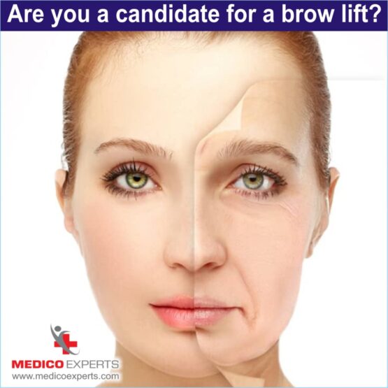 are you candidate for brow lift