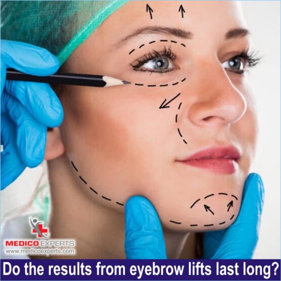 browlift surgery