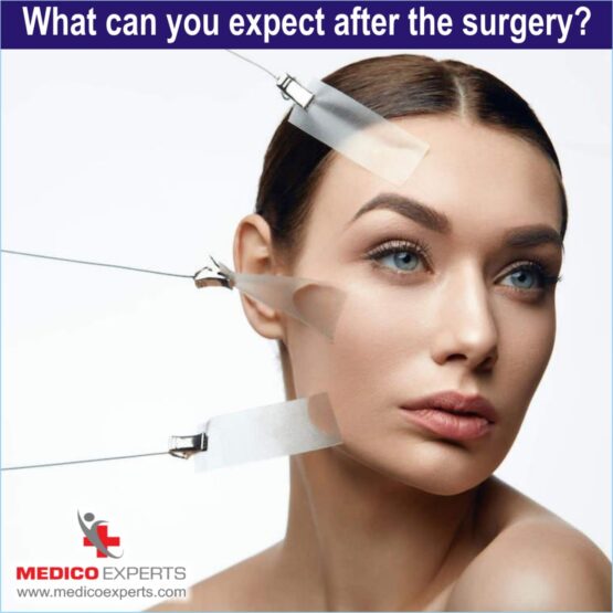 browlift surgery