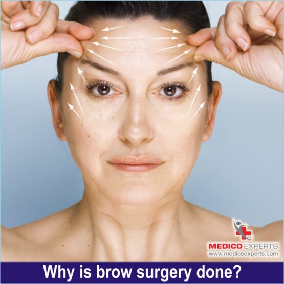 why browlift surgery done