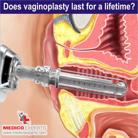 Vaginoplasty in India