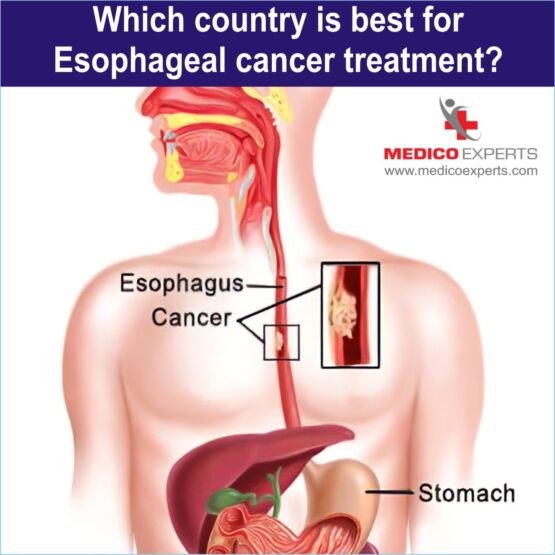 best hospital for esophageal cancer treatment in india, esophageal cancer treatment in india, esophageal cancer treatment