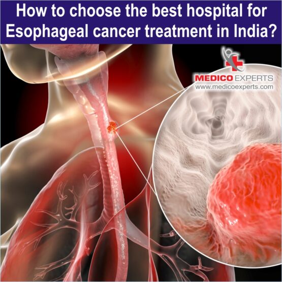 best hospital for esophageal cancer treatment in india, esophageal cancer treatment in india