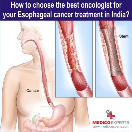 best esophageal cancer doctors in india, esophageal cancer doctors