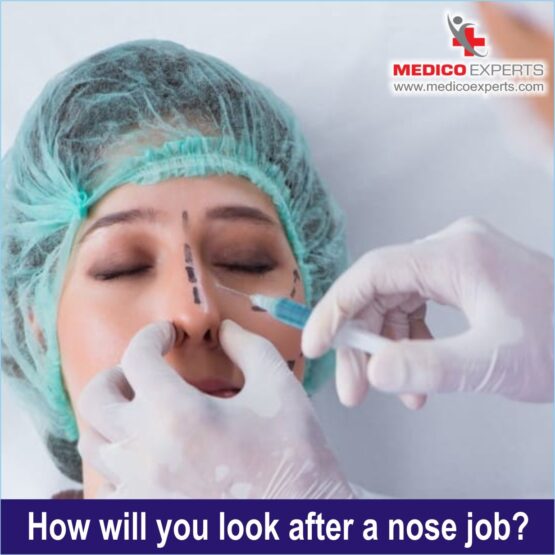 How will you look after a nose job Rhinoplasty Surgery in india