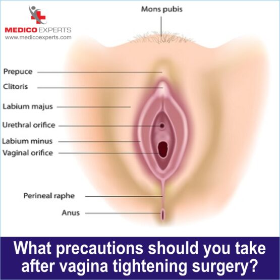 Vaginoplasty in India