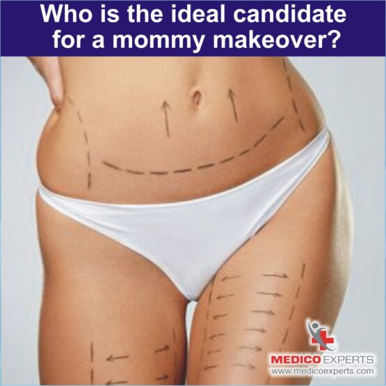 Who is the ideal candidate for a mommy makeover