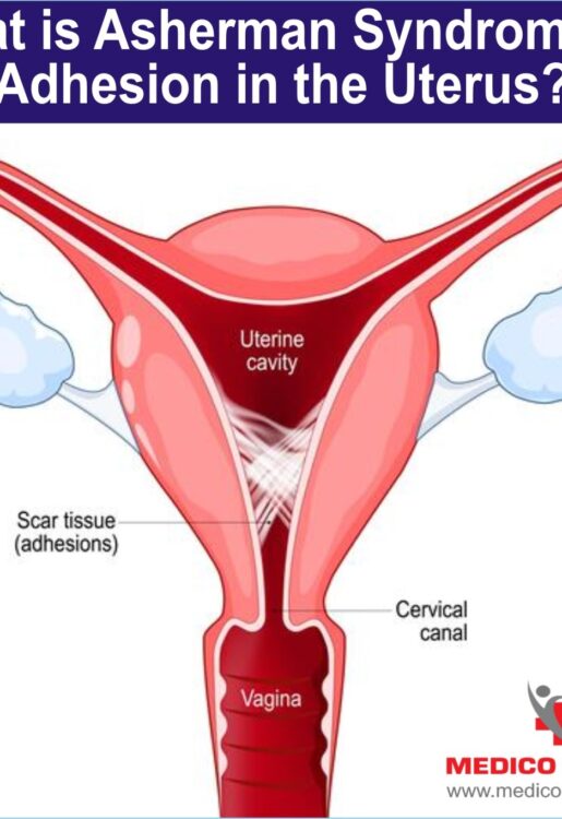 What is Asherman Syndrome or Adhesion in the uterus?