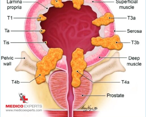 What is Intravesical BCG?