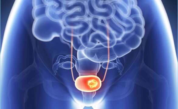 BCG treatment for bladder cancer