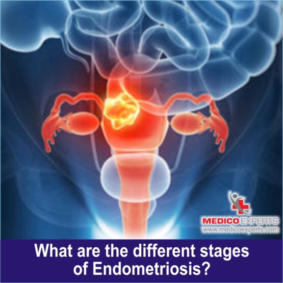 endometriosis india, "endometriosis treatment for infertility