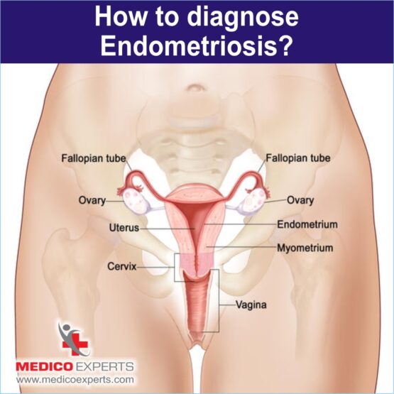 endometriosis treatment for infertility, best endometriosis treatment in india