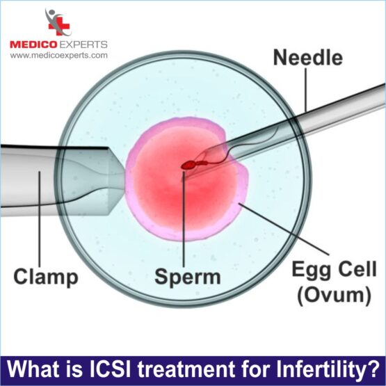 what is icsi treatment ?, icsi treatment for infertility