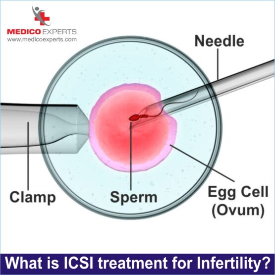what is icsi treatment ? what is icsi treatment ?, icsi treatment for infertility