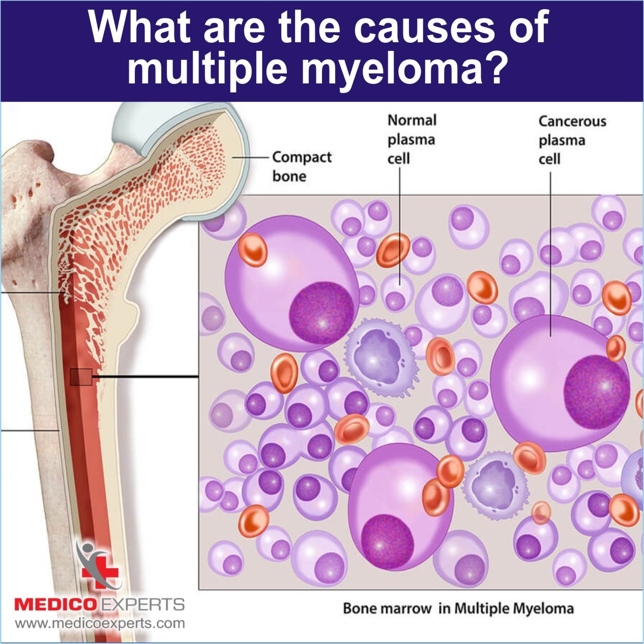 New multiple myeloma treatment in India without recurrence