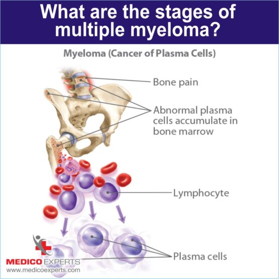 New multiple myeloma treatment in India without recurrence