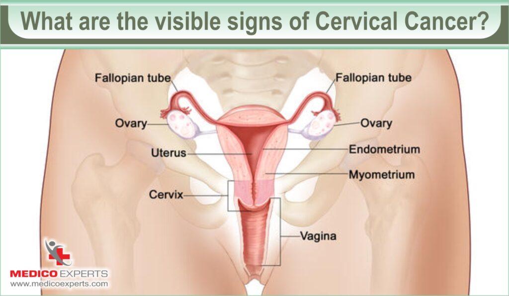 how i knew i had cervical cancer, visible signs of cervical cancer