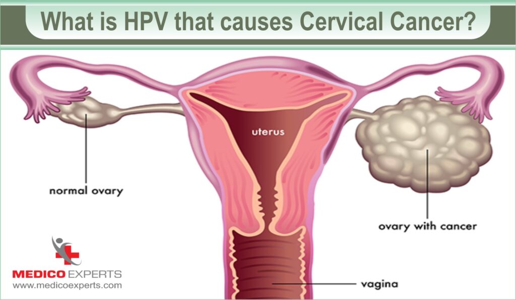 how i knew i had cervical cancer, earliest symptoms of cervical cancer