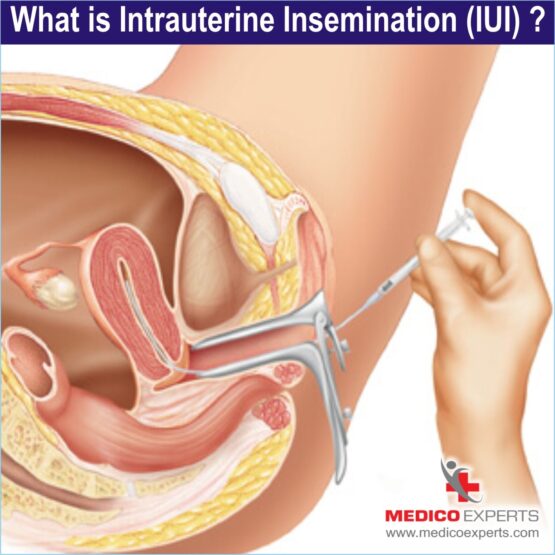 iui treatment in india, what is iui treatment?