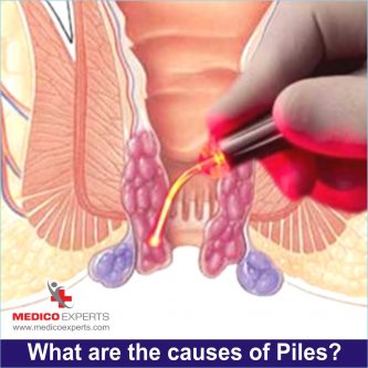 Causes of piles, permanent treatment for piles