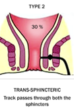 Transphincteric