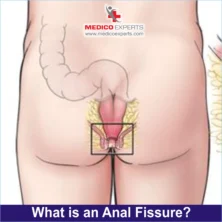 what is anal fissure?