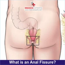 what is anal fissure? what is anal fissure?
