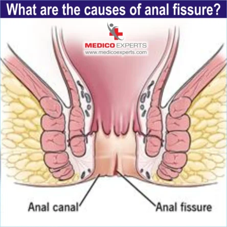 causes of anal fissure