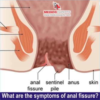symptoms of anal fissure symptoms of anal fissure