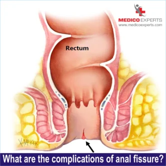 complications of anal fistula
