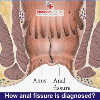 anal fissure diagnosed