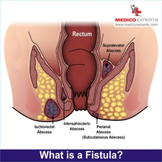 what is fistula?