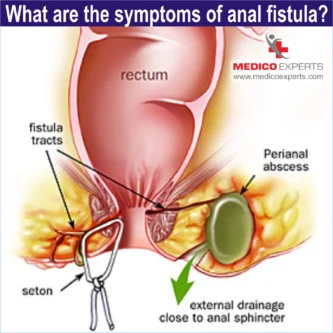 Symptoms of anal fistula