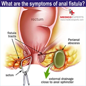 Symptoms of anal fistula Symptoms of anal fistula